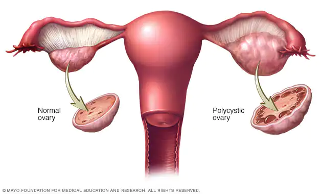 PCOS-NUFORMIX